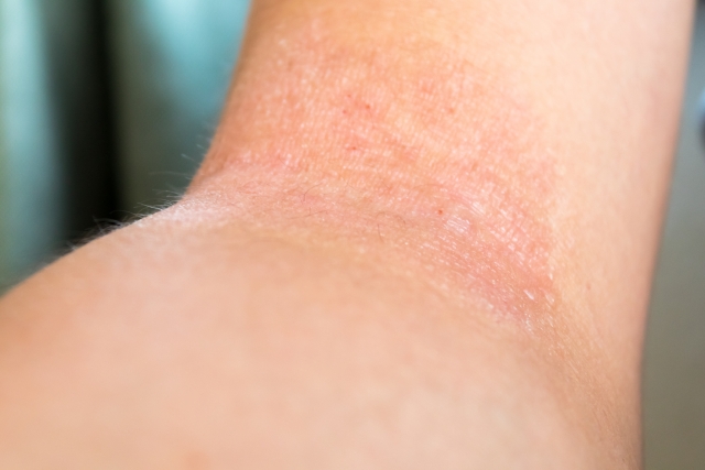 アトピー性皮膚炎の写真
