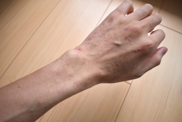 アトピー性皮膚炎の腕